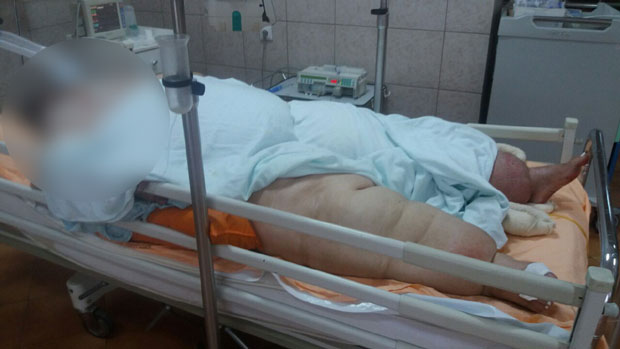 Борба за живот жене тешке 300 килограма